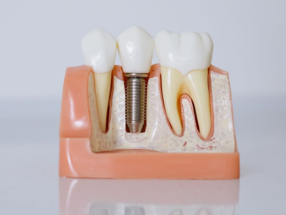 Oral Prophylaxis / Cleaning